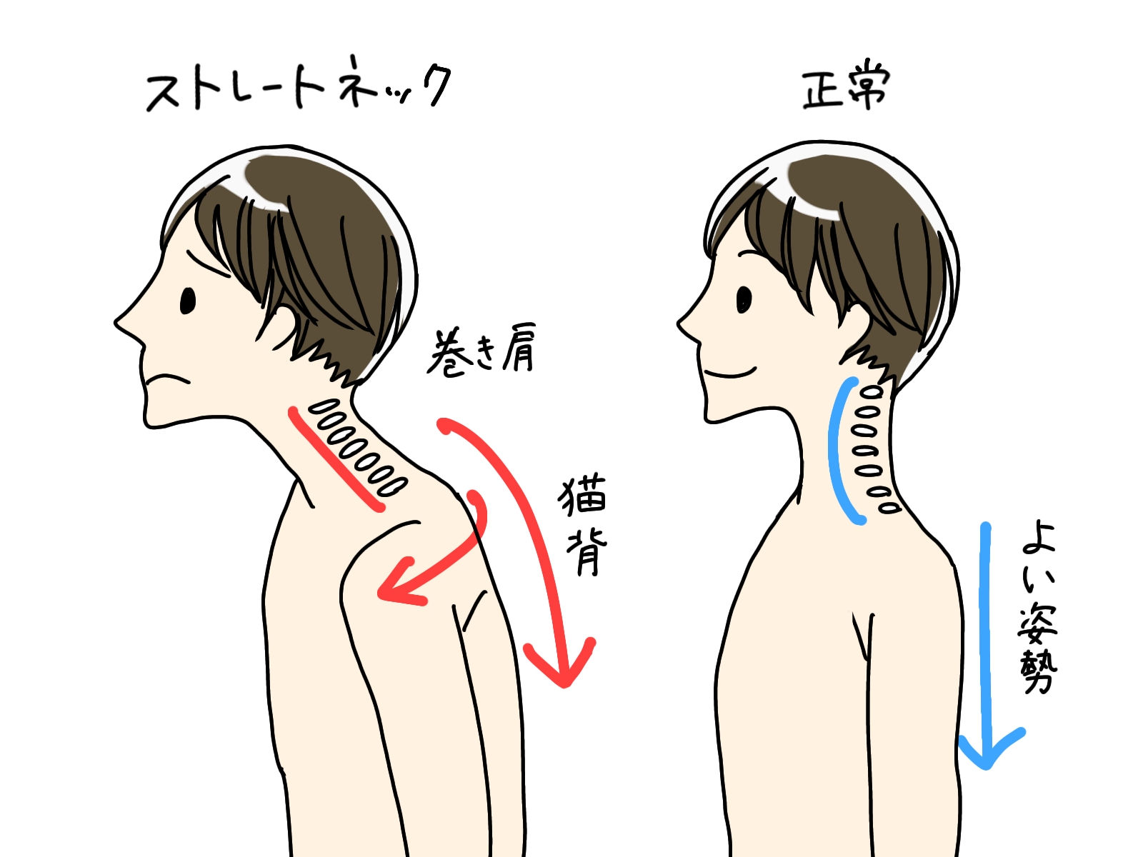 スマホ首・肩こり・頭痛…その原因はストレートネック？戸塚のゼロスポ
